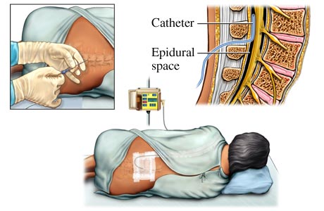 Epidural