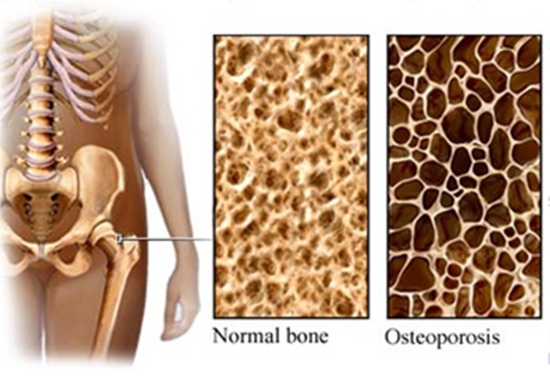 tulang sehat dan osteoporosis