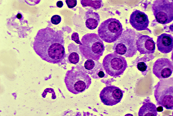 sel myeloma