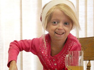 Progeria, Penuaan Pada Anak