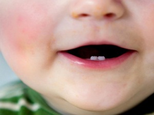 Tumbuh Gigi? Hindari Penggunaan Benzocaine Pada Bayi Anda